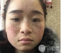 黑脸娃娃去斑成好吗，真人测评前后对比照片