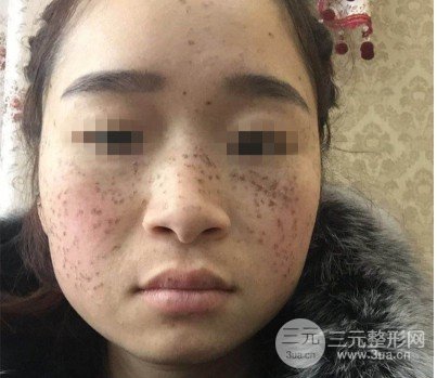 黑脸娃娃去斑成好吗