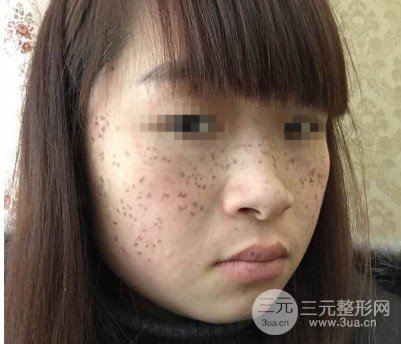 黑脸娃娃去斑成好吗