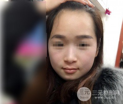 黑脸娃娃去斑成好吗