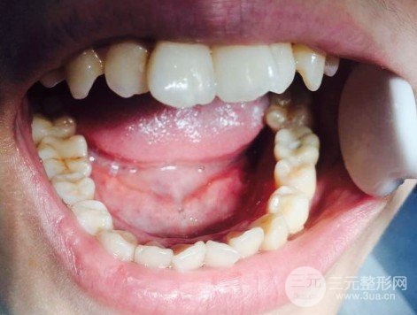 北海牙博士口腔种植牙案例
