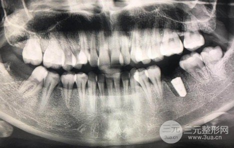 北海牙博士种植牙案例