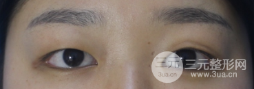 开眼角和不开眼角图片