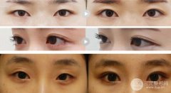 开眼角和不开眼角图片对比 术前必看美眼攻略！