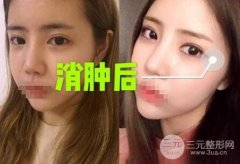 全切双眼皮1个月过程图 想美别着急，先度过恢复期！