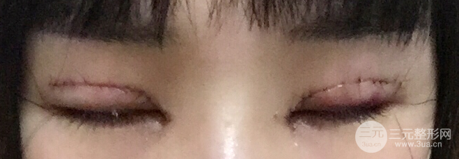 全切双眼皮1个月过程图