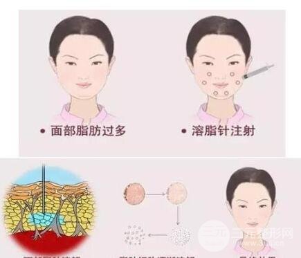 注射溶脂瘦脸恢复时间?