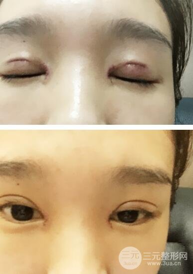 开眼角案例