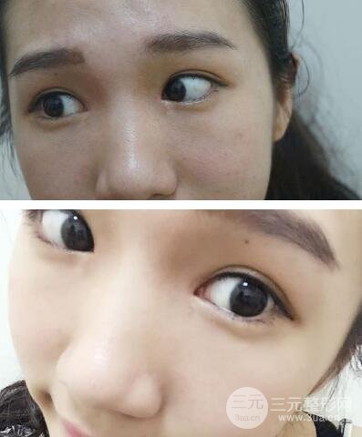 开眼角案例