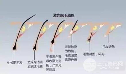 激光脱毛需要脱几次?