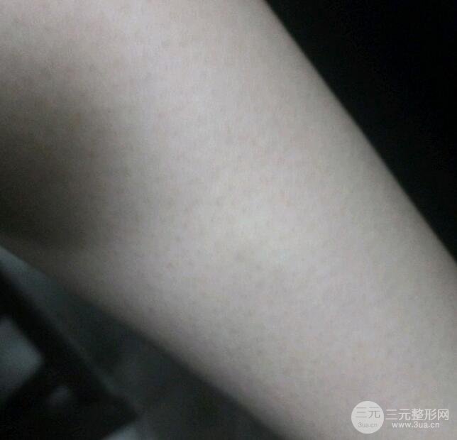 脱毛案例