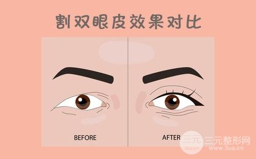 [科普]割双眼皮有哪些风险？术前术后注意事项大全~