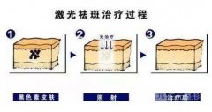 激光嫩肤需要多少钱？搞定黑头毛孔的杀手锏