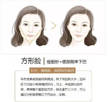 玻尿酸丰下巴价格