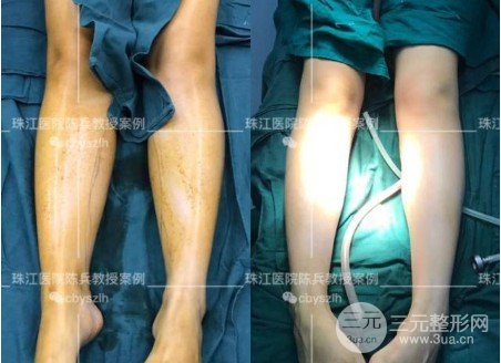 腿部吸脂需要多少钱