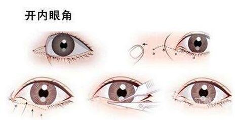 开眼角手术原理: