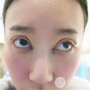 开眼角手术案例