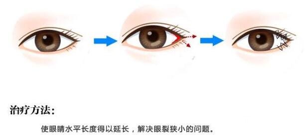 开外眼角的危害