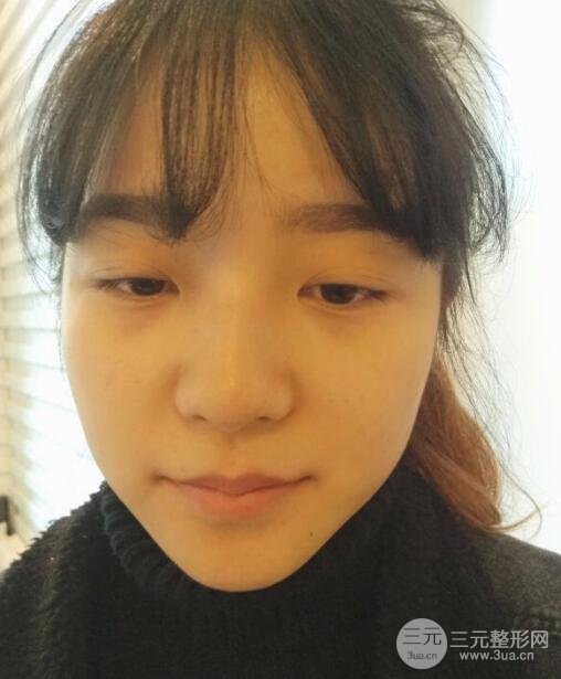 全切双眼皮+开眼角案例