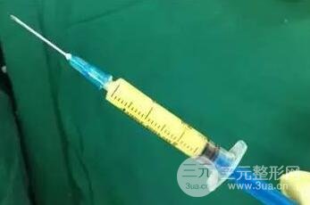脂肪填充的手术原理