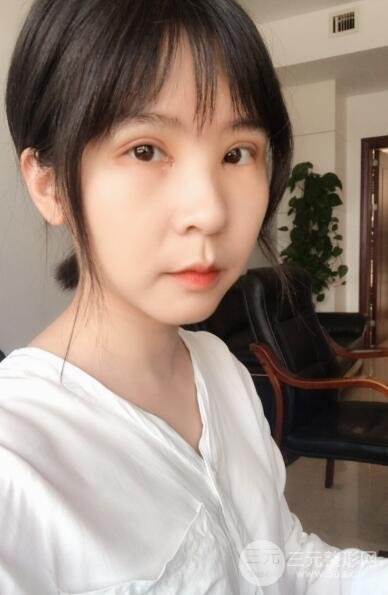 双眼皮韩式切开手术案例