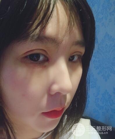 双眼皮韩式切开手术案例