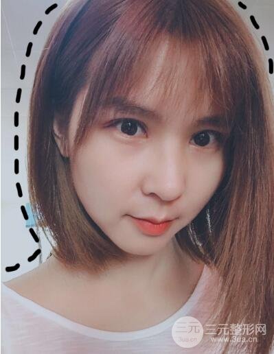 双眼皮韩式切开手术案例