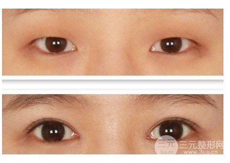 开大眼角手术果对比图