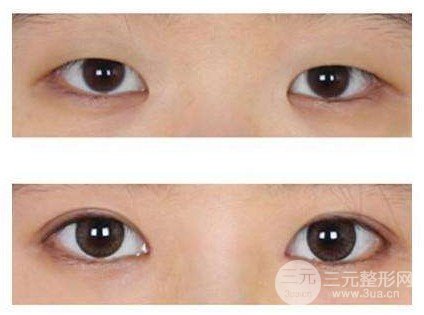 开大眼角手术果对比图