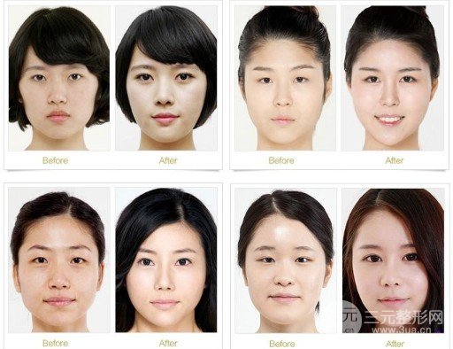 开大眼角手术果对比图