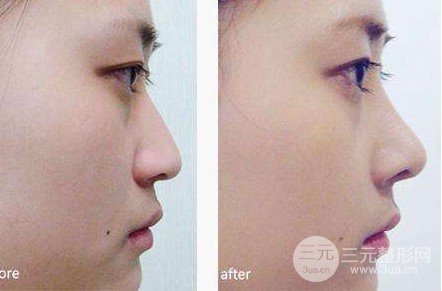 注射隆鼻前后对比图