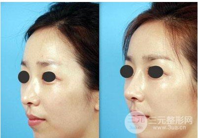 注射隆鼻前后对比图