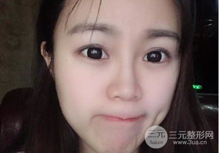 注射胶原蛋白隆鼻多少钱