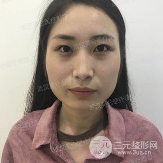 面部精细吸脂经历