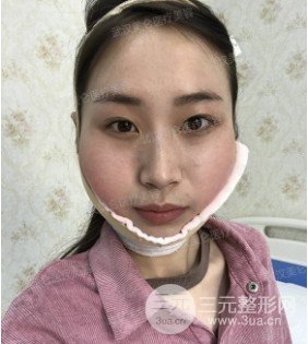 面部精细吸脂经历