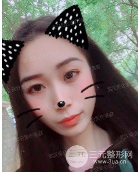 面部精细吸脂经历