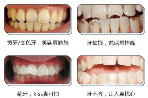 全瓷烤瓷牙价格