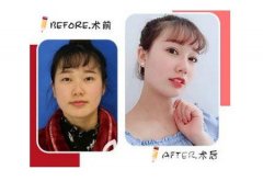 自体软骨隆鼻要多少钱?术后促进恢复注意这5点! 自体软骨隆鼻要多少钱?术后促进恢复注意这5点!