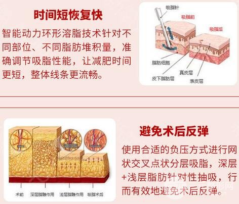 减肥吸脂术实际果如何
