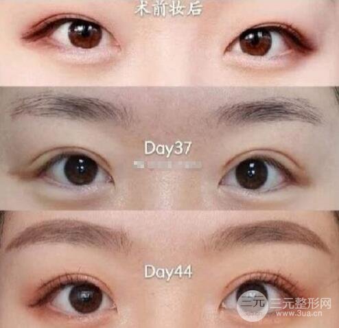 双眼皮手术后恢复期