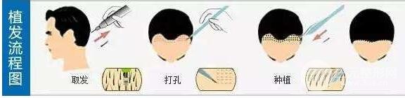 发际线整形价格