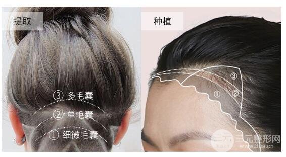 发际线整形适合的人群