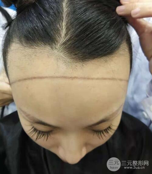 植发案例