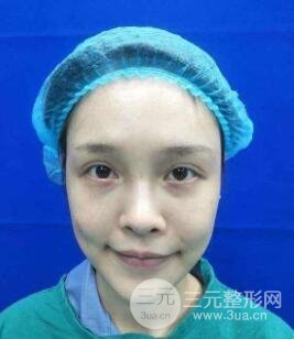 酒窝手术失败图片