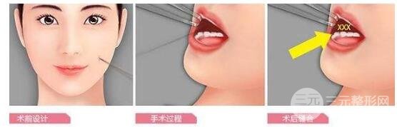 酒窝手术的注意事项