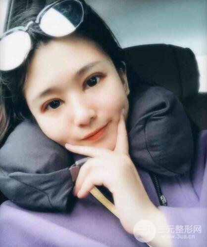 双眼皮手术失败案例