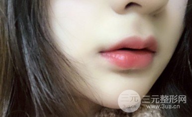 玻尿酸丰唇术优缺点