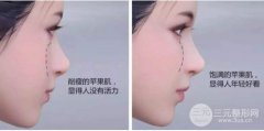 玻尿酸丰面颊费用多少?价格差距怎么那么大? 玻尿酸丰面颊费用多少?价格差距怎么那么大?