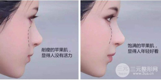 面部填充手术方法