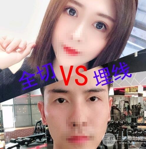 埋线双眼皮的优势